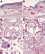 Thumbnail of Pulmonary histopathology in fatal coronavirus disease cases caused by severe acute respiratory syndrome coronavirus 2 infection. A) Patient no. 5: tracheitis characterized by moderate mononuclear inflammation within the submucosa (original magnification ×10). B) Patient no. 3: extensive denudation of tracheal epithelium; submucosal congestion, mild edema, and mononuclear inflammation (original magnification ×10). C) Patient no. 4: exudative phase of diffuse alveolar damage character