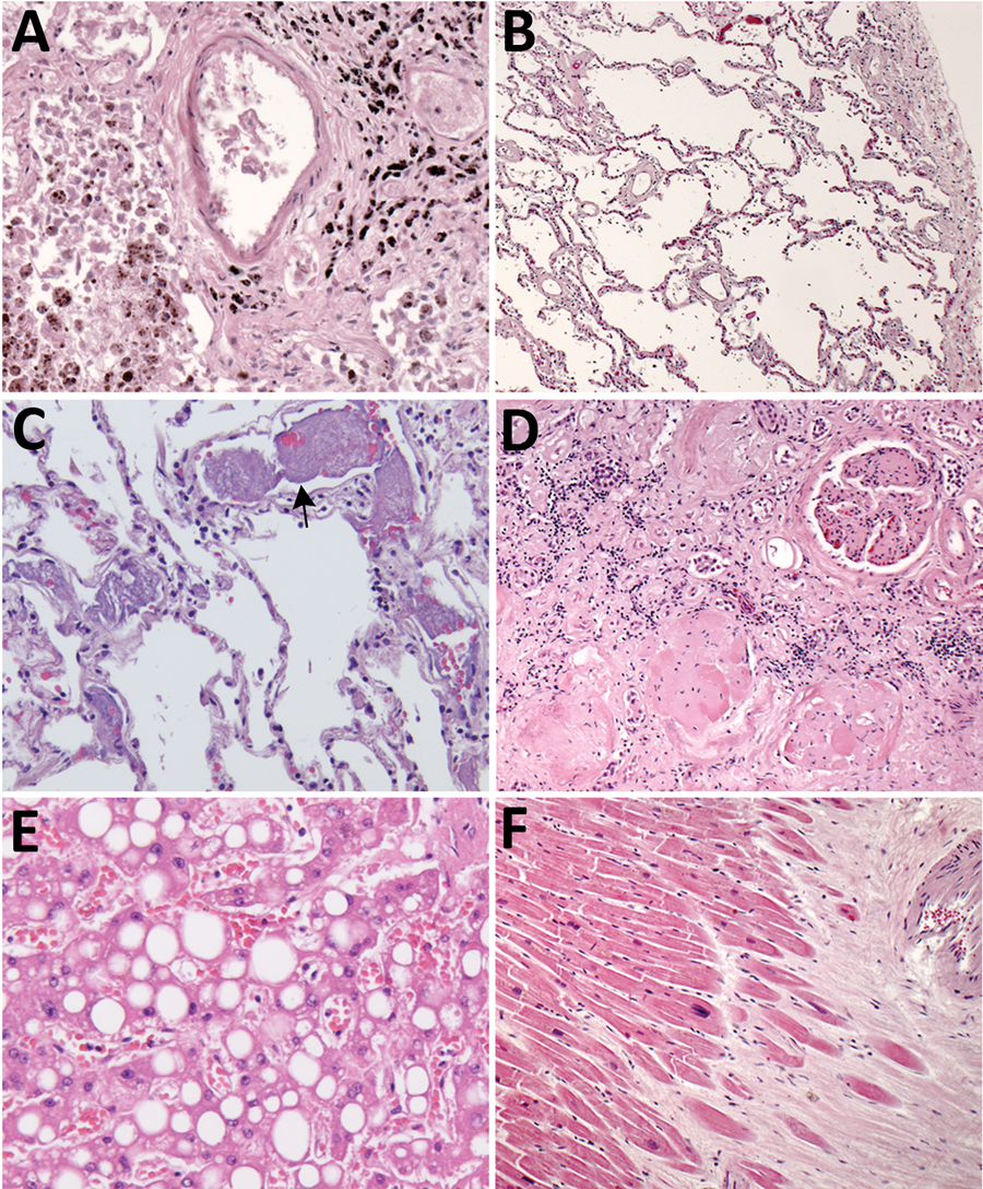 Histopathologic findings associated with underlying conditions in fatal coronavirus disease. A) Patient no. 2: lung, hemosiderin-laden macrophages (brown pigment, bottom left), and anthracosis (black pigment, top right) in a patient with congestive heart failure (original magnification ×20). B) Patient no. 3: lung, emphysema in a patient with chronic obstructive pulmonary disease (original magnification ×5). C) Patient no. 7: lung, pulmonary microthrombosis (arrow) (original magnification ×20). 