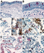 Thumbnail of Immunostaining of severe acute respiratory syndrome coronavirus 2 in pulmonary tissues from fatal coronavirus disease cases. A) Patient no. 5: scattered immunostaining of tracheal epithelial cells (original magnification ×40). B) Patient no. 5: higher magnification shows immunostaining of ciliated cells (original magnification ×63). C) Patient no. 8: immunostaining of desquamated type I pneumocyte in an alveolar lumen (original magnification ×63). D) Patient no. 4: colocalization of