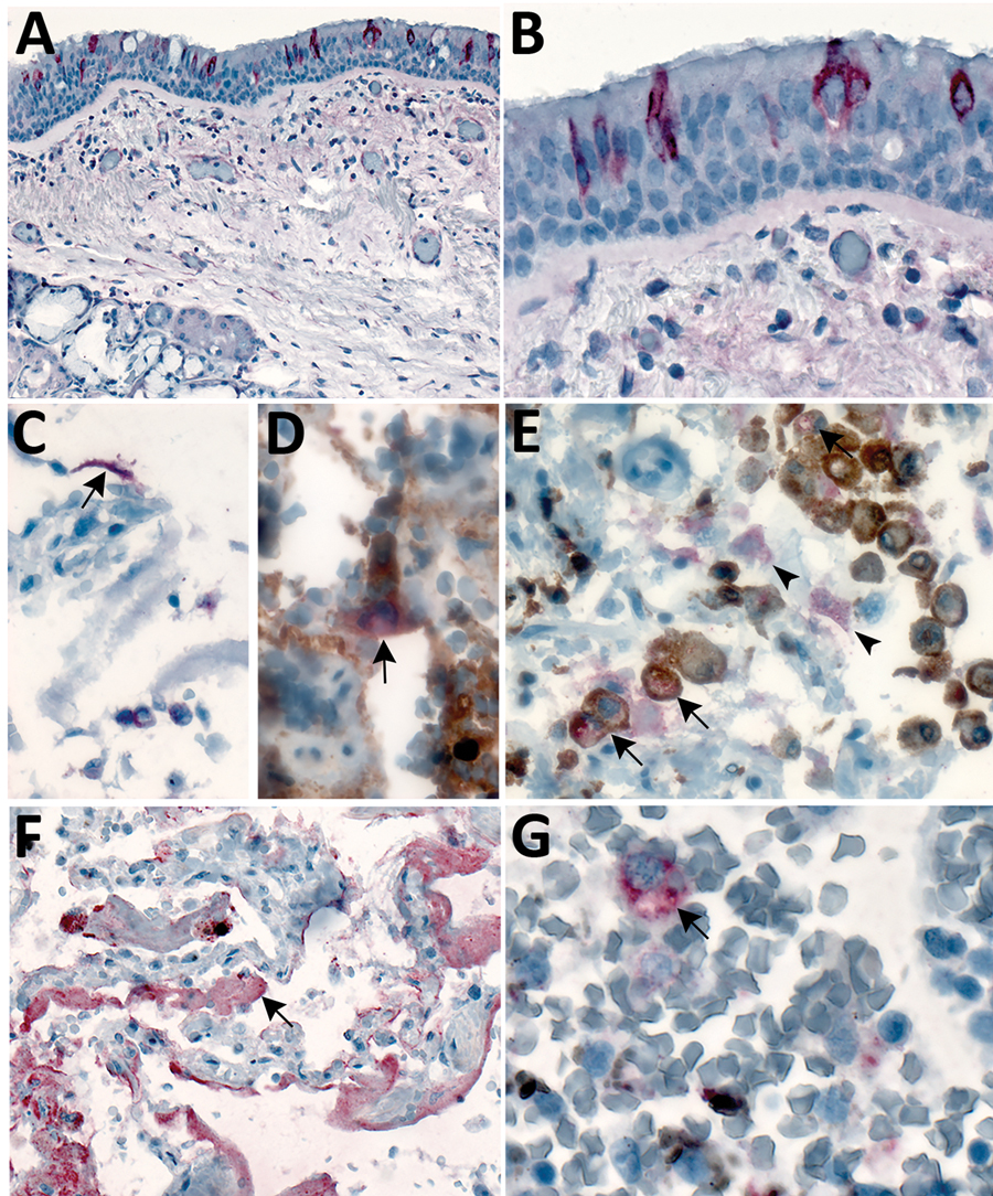 Immunostaining of severe acute respiratory syndrome coronavirus 2 in pulmonary tissues from fatal coronavirus disease cases. A) Patient no. 5: scattered immunostaining of tracheal epithelial cells (original magnification ×40). B) Patient no. 5: higher magnification shows immunostaining of ciliated cells (original magnification ×63). C) Patient no. 8: immunostaining of desquamated type I pneumocyte in an alveolar lumen (original magnification ×63). D) Patient no. 4: colocalization of SARS-CoV-2 v