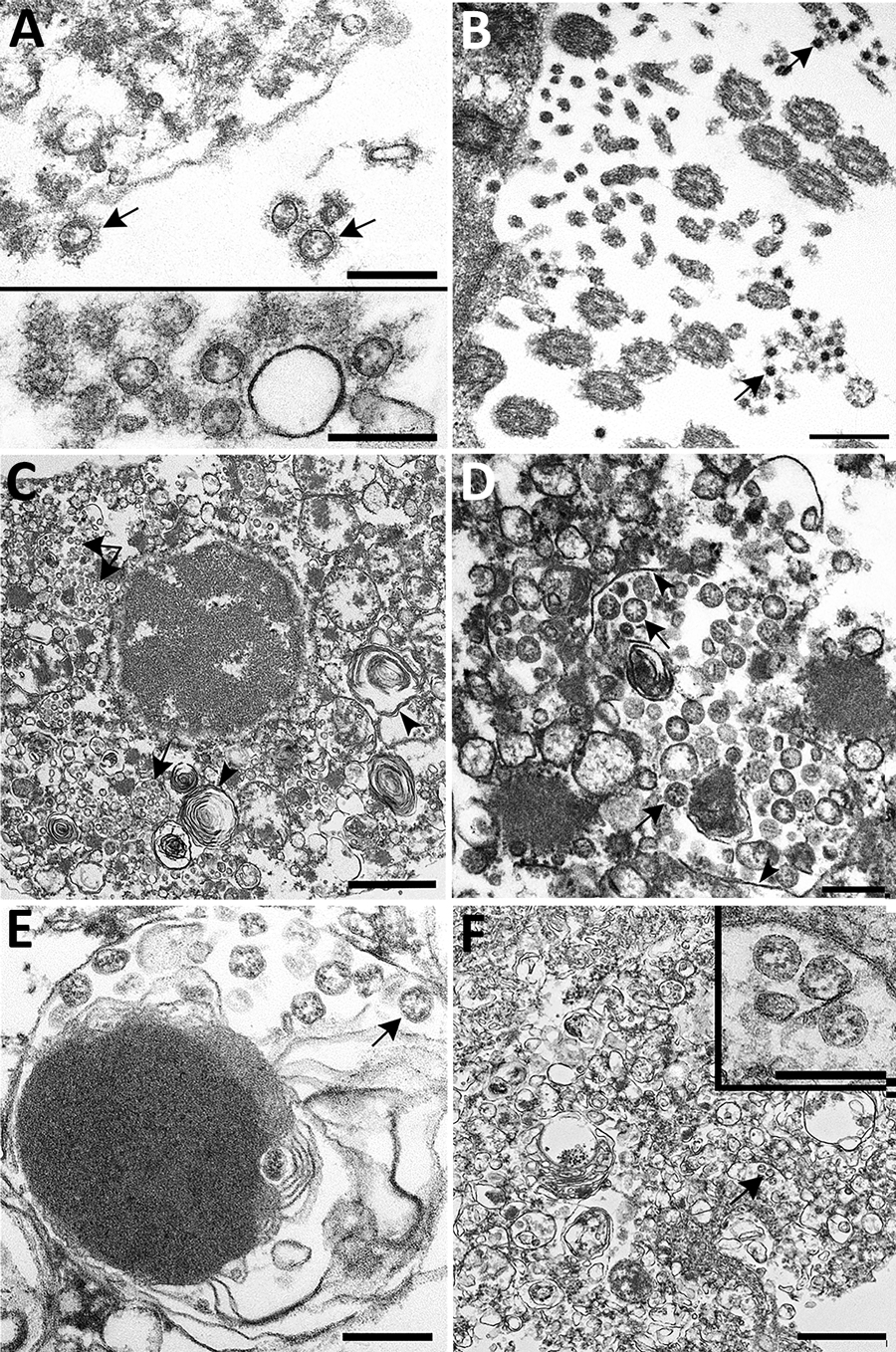 Ultrastructural features of severe acute respiratory syndrome coronavirus 2 lung infection in fatal coronavirus disease. A) Top: alveolar space containing extracellular virions (arrows) with prominent surface projections. Bottom: cluster of virions in the alveolar space. Scale bars indicate 200 nm. B) Extracellular virions (arrow) associated with ciliated cells of the upper airway. Scale bar indicates 200 nm. C) Membrane-bound vacuoles (arrows) containing viral particles within the cytoplasm of 
