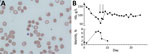 Thumbnail of Testing of patient with G6PD deficiency and SARS-CoV-2 infection, United Kingdom. A) Blood film showing normochromic normocytic erythrocytes and a few hemighost cells. Hemighost cells are formed after oxidative hemolysis seen in G6DP deficiency. Hb is contracted to 1 pole of the cell, leaving an unfilled area enclosed by an intact membrane (original magnification ×100). B) Hb and metHb concentration during admission. Each arrow indicates a 3-unit erythrocyte transfusion. G6PD, gluco