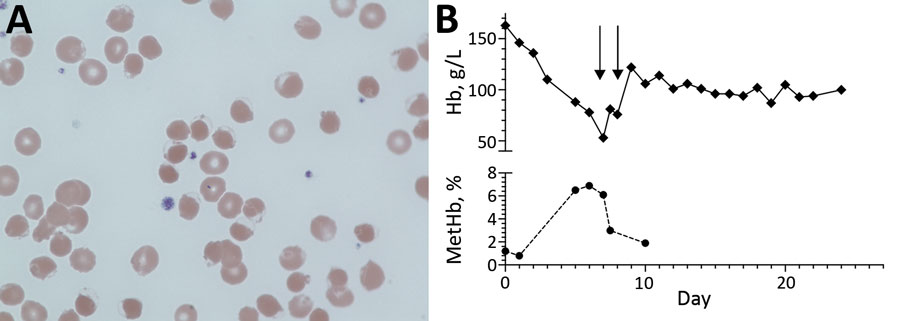 Testing of patient with G6PD deficiency and SARS-CoV-2 infection, United Kingdom. A) Blood film showing normochromic normocytic erythrocytes and a few hemighost cells. Hemighost cells are formed after oxidative hemolysis seen in G6DP deficiency. Hb is contracted to 1 pole of the cell, leaving an unfilled area enclosed by an intact membrane (original magnification ×100). B) Hb and metHb concentration during admission. Each arrow indicates a 3-unit erythrocyte transfusion. G6PD, glucose-6-phosphat