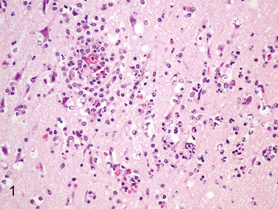 Brain specimen from Mexican wolf pup infected with eastern equine encephalitis virus at Binder Park Zoo, Michigan, USA. Hematoxylin and eosin stain shows severe, acute necrotizing and neutrophilic encephalitis with neuronal necrosis with pyknotic nuclei associated with perineuronal satellitosis and neutrophilic neuronophagia.