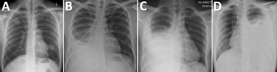 Plain chest radiographs of 4 patients with severe acute respiratory syndrome coronavirus 2 and Mycobacterium tuberculosis co-infection, Singapore. A) Patient 1, showing bilateral cavitary lesions; B) patient 2, showing a large right-sided loculated pleural effusion and adjacent consolidation; C) patient 3, showing a large right-sided pleural effusion with adjacent compressive atelectasis; D) patient 4, showing a large left-sided pleural effusion with adjacent consolidation.
