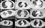 Representative computed tomography (CT) scans for 9 patients with aspergillosis complicating severe viral pneumonia in patients with coronavirus disease. Scans were obtained at or around diagnosis of coronavirus disease–associated pulmonary aspergillosis in this series of patients, described in the Table (https://wwwnc.cdc.gov/EID/article/27/1/20-2896-T1.htm). Corresponding case-patients are indicated with lettered superscripts in the radiology column of Table 1. Examples of nodules and cavitating nodules are indicated by red arrows, and prominent airway thickening and bronchiectasis in ground glass opacities are indicated by red stars.