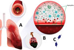 Schematic of coronavirus disease–associated pulmonary aspergillosis. Aspergillus conidia in airway are cleared poorly because of ≥1 defects in primary pulmonary immunity or secondary defenses, enabling conidial germination into hyphal morphotypes, which elicit increased inflammatory responses in the airway and potential invasion into the lungs. A mixed constellation of inflammatory to invasive airway disease, and invasive pulmonary aspergillosis leads to multiple manifestations, including tracheobronchitis and obstructive pneumonia, and complications of invasive fungal pneumonia (nodules, necrosis with cavities, pleural invasion). A) Airways. Aspergillus overgrowth causes pathologic airway inflammation and excess mucous production. B) Alveoli. Hyphal growth causes invasive pneumonia. C) Invasive aspergillosis tracheobronchitis postobstructive bacterial pneumonia.