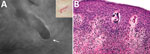 Imaging and biopsy results for patient with cutaneous larva migrans, Turin, Italy. A) Fluorescence-advanced videodermatoscopy showed larva with a diameter of 70–80 μm, located intraepidermally, ≈0.5 cm to the right of the distal end of the serpentine path (indicated in the inset) caused by its passage in the skin. White arrow indicates head of the larva (original magnification ×500). B) Hematoxylin and eosin–stained longitudinal skin section obtained from a 4-mm biopsy specimen, showing the cavity at the epidermal level in which it is possible to observe the larva inside (original magnification ×20). Once the biopsy specimen was obtained, confirmation of a larva by morphologic details or molecular techniques was necessary to differentiate animal nematodes from other larvae, particularly Strongyloides stercoralis, because treatment and follow-up would be different.