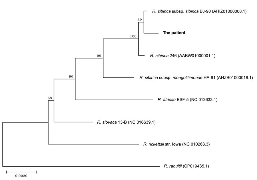 Phylogenetic analysis of concatenated nucleotide sequences from Rickettsia species collected in 2018 from eschar DNA from a patient in Qinghai Tibet Plateau, China (boldface), and reference sequences. A phylogenetic tree was constructed on the basis of the concatenated partial gltA, ompA, ompB, 17 kDa, sca1, and sca4 nucleotide sequences by using the neighbor-joining method with 1,000 bootstrap replicates. Numbers >70 indicate the bootstrapping value. GenBank accession numbers listed in Appendix Table 3 . Scale bar represents nucleotide substitutions.
