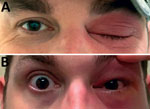 Patient with acute Chagas disease manifesting as orbital cellulitis, Texas, USA, on the day he first accessed care. A) Left periorbital edema and erythema. B) Conjunctival injection.