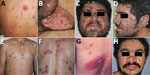 Lesions of patients with disseminated cutaneous leishmaniasis, Baturité region, Ceará State, Northeast Brazil, 2015–2018. Patient numbers match those given in Table 1. A) Ulcerated, acneiform, and papular lesions on the back of patient 1. B) Ulcerated lesions on the genitalia of patient 2. C–D) Crusted and crusted-horny lesions on the face of patient 3. E) Papular, crusted, and ulcerated lesions on the trunk of patient 3. F) Crusted, ulcerated, and papular lesions on the back of patient 6. G) Ulcer surrounded by zosteriform and papular lesions on the back of patient 11. H) Papular, crusted, and ulcerated lesions on the face as well as an ulcerated and crusted-horny lesion on the superior right eyelid of patient 12.