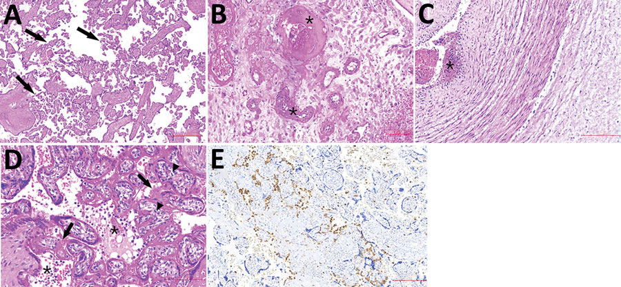 Histologic sections from the placenta of stillborn fetus of a woman with severe acute respiratory syndrome coronavirus 2 infection, Brazil, 2020. Tissue stained with hematoxylin and eosin. A) Placenta shows accelerated villous maturation with increase in syncytial knots. Black arrows indicate small or short hyper mature villi. B) Membranes and basal decidua show decidual arteriopathy, including fibrinoid necrosis with foam cells, mural hypertrophy, absence of spiral artery remodeling, and arterial thrombosis associated with decidual infarct. Asterisks (*) indicate fibrinoid necrosis. C) The umbilical cord shows subendothelial edema and nonocclusive arterial thrombosis, which was also focally observed in a chorionic plate and stem vessels. Asterisks (*) indicate arterial thrombosis. D–E) Photomicrographs show diffuse perivillous fibrin deposition associated with multifocal mononuclear inflammatory infiltrate in the intervillous space and occasional intervillous thrombi. Black arrows indicate fibrin deposition; asterisks (*) indicate mononuclear infiltrate; arrowheads indicate increase in number of Hofbauer cells. E) Immunohistochemical assay using CD68 antibodies highlights histiocyte infiltrate in paraffin-embedded samples (KP1 Clone; Biocare Medical LLC, https://biocare.net).