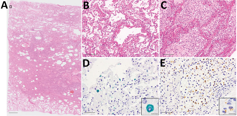 Microscopic findings of the lungs of a patient in Japan co-infected with SARS-CoV-2 and Streptococcus pneumoniae. A) Histopathology of lung section R12 (shown in Figure 1). Scale bar indicates 2 mm. B) Magnified image of the black square (top left) in panel A: exudative phase of diffuse alveolar damage (DAD) with hyaline membranes. Scale bar indicates 100 μm. C) Magnified image of the red square (bottom right) in panel A: edema and bronchopneumonia with massive infiltration of neutrophils in the alveolar spaces. Scale bar indicates 100 μm. D, E) Magnified images of the same areas of consecutive sections as B and C, respectively, showing SARS-CoV-2 antigen stained green (Vina green) and S. pneumoniae antigen stained brown (3,3′-diaminobenzidine) by enzyme-labeled double immunohistochemistry. The SARS-CoV-2 antigens were detected predominantly in the DAD area (D; scale bar indicates 50 μm). The S. pneumoniae antigens were detected predominantly in the bronchopneumonia area (E; scale bar indicates 50 μm). Insets show magnified images of the staining cells (scale bars indicate 10 μm).