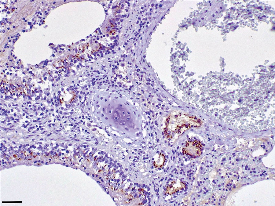 Lung tissue from a Mediterranean monk seal pup that died shortly after it was found along the southern Adriatic coast of Italy, showing positive immunostaining for morbillivirus antigen in bronchial/bronchiolar and alveodar epithelial cells, both normal and hyperplastic. Immunohistochemical analysis using an antibody against the nucleoprotein antigen of canine distemper virus (1:100 dilution), Mayer hematoxylin counterstained. Scale bar indicates 100 μm.