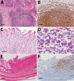 Histopathological lesions in the intestinal tracts from fatal cases of severe fever with thrombocytopenia syndrome (SFTS) in cats, Japan. A, B) Hematoxylin & eosin (HE)–stained (B) and immunohistochemistry-stained (A) ileum sections demonstrating enlargement of Peyer’s patch and accumulation of SFTSV-positive blastic lymphocytes. Scale bars indicates 100 μm. C) HE-stained colon sections demonstrating infiltration of lymphocytes into the lamina propria. Scale bar indicates 100 μm. D) High power magnification of panel C demonstrating the infiltrating lymphocytes were blastic lymphocytes. Scale bar indicates 10 μm. E, F) HE stained (E) and immunohistochemistry-stained (F) ulcerative lesions in the cecum. Scale bars indicate 200 μm. 