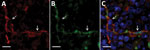 Double-labeling immunofluorescent staining of the thymus from fatal cases severe fever with thrombocytopenia syndrome (SFTS) in cats, Japan. Arrows indicate thymic epithelial cells. A, D) Red indicates signals of cytokeratin. B, E) Green indicates signals of SFTS virus. C, F) Blue indicates nuclei labeled with DAPI. Scale bars indicate 10 μm.