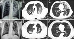 Comparison of chest radiographs and computed tomography scans before and after the end of treatment for a 65-year-old male goat breeder infected with Mycobacterium caprae, northern Greece, 2019. Multiple cavity infiltrations and opacities are shown on the chest radiographs (A) and the computed tomography scan (B, C), mainly in the left upper lobe. After treatment, significant improvement is shown by cavity closure and recession of opacities and infiltration on the chest radiograph (D) and on the chest computed tomography scans (E, F).