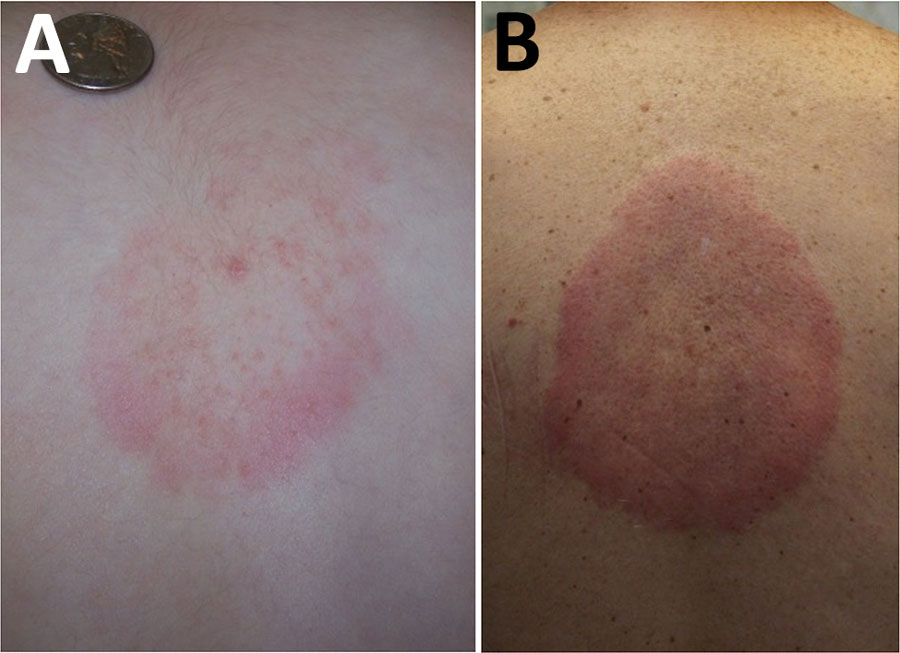 Southern tick-associated rash illness skin lesions. Adapted from Centers for Disease Control and Prevention, National Center for Emerging and Zoonotic Infectious Diseases, Division of Vector-Borne Diseases.