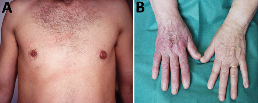 A) Borrelial lymphocytoma on nipple, showing local swelling and a remnant of erythema migrans on chest; at the time of diagnosis, the lesions had been noticed for 6 weeks. B) Acrodermatitis chronica atrophicans involving the right hand, showing red-purple discoloration, swelling, and skin atrophy; at the time of diagnosis, the lesions had been noticed for ≈2.5 years.