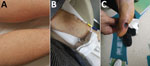 Skin manifestations of patients in study of confirmation of Rickettsia conorii subspecies indica infection by next-generation sequencing, Shandong, China. A) Rash in patient 1; B) rash in patient 2; C) eschar in patient 3 