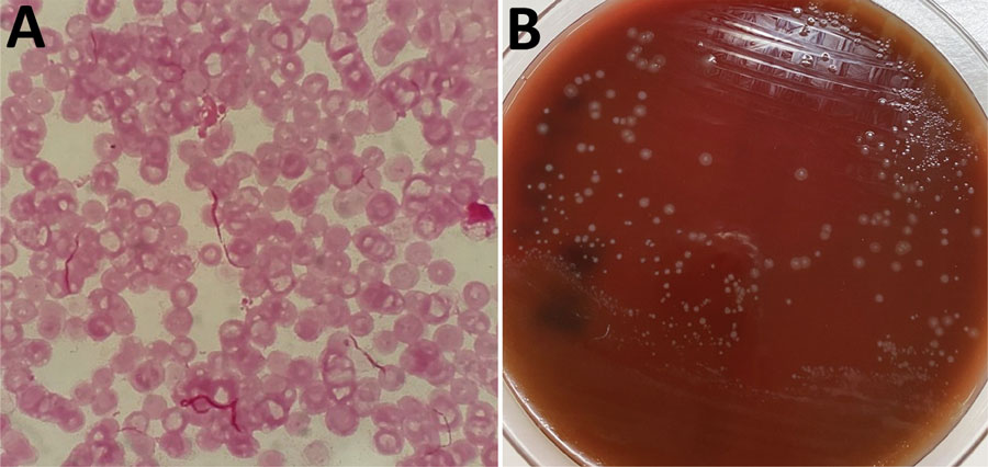 Results of testing for the causative agent of rat-bite fever in a 70-year-old woman in Japan. A) Gram-stained blood smear showing chain-shaped gram-negative bacilli; original magnification ×1,000. B) Small, smooth colonies in culture of healthy human serum (provided by one of the authors of this article) on 5% sheep blood agar. Further testing identified the bacilli as Streptobacillus notomytis.