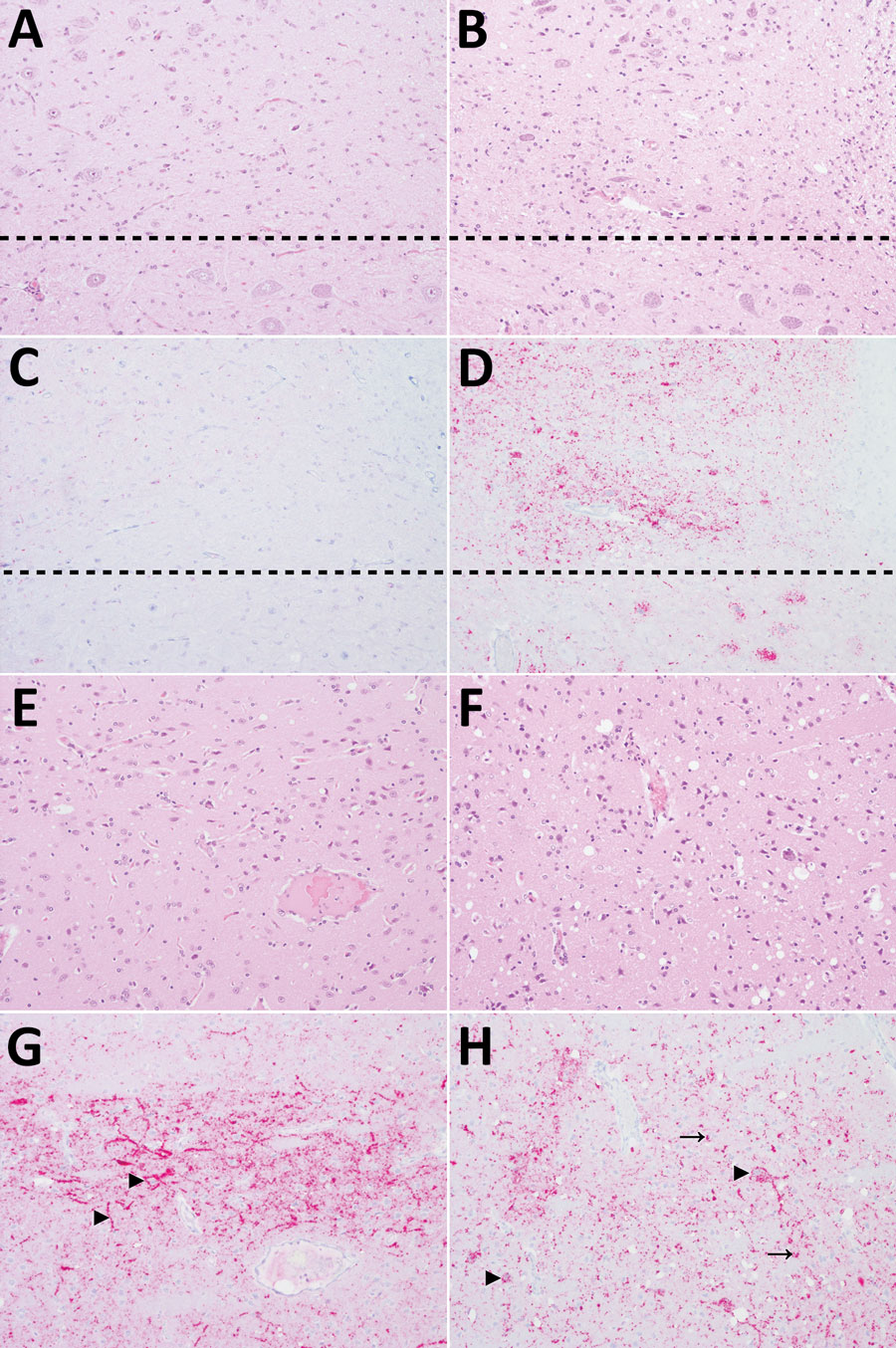 Patterns of histopathology and immunohistopathology in brains from 2 raccoons inoculated with the agent of chronic wasting disease (CWD). Panels A, C, E, and G show results for raccoon 2, inoculated with the agent of CWD from white-tailed deer; panels B, D, F, and H) show results for raccoon 9, inoculated with CWD from a vole that had been inoculated with the 4th vole-passage of the agent of CWD from white-tailed deer. All images original magnification ×20. A–D) Medulla at the level of the obex. A) Raccoon 2 shows no spongiform change in the dorsal motor nucleus of the vagus nerve (DMNV) (above dashed line) or hypoglossal nucleus (below dashed line). Hematoxylin and eosin (H&E) stain. B) Raccoon 9 shows mild to moderate spongiform change in the DMNV. H&E stain. C) Raccoon 2 shows very mild PrPSc immunoreactivity in the DMNV and no immunoreactivity in neurons of the hypoglossal nucleus. PrP antibodies F89/160.1.5 and F99/97.6.1. D) Raccoon 9 shows moderate PrPSc immunoreactivity in the neuropil of the DMNV and marked intraneuronal immunoreactivity in the hypoglossal nucleus. PrP antibodies F89/160.1.5 and F99/97.6.1. E–H) Caudate nucleus. E) Raccoon 2 shows moderate diffuse spongiform change. H&E stain. F) Raccoon 9 shows marked diffuse spongiform change. H&E stain. G) Raccoon 2 shows diffuse neuropil PrPSc immunoreactivity and prominent extracellular PrPSc accumulation on neurons (arrowheads). PrP antibodies F89/160.1.5 and F99/97.6.1. H) Raccoon 9 shows marked intracellular PrPSc immunoreactivity in neurons (arrowheads) and glial cells (arrows). PrP antibodies F89/160.1.5 and F99/97.6.1.