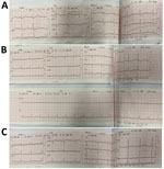 Results of 12-lead electrocardiograms conducted on a 7-year-old boy later diagnosed with diphtheria myocarditis, Vietnam, 2020. A) At hospital admission (day 10 of illness), electrocardiography showed an incomplete right bundle branch block (RSR) in V1–3 with QRS duration of 92 ms), QTc prolongation (519 ms), and ST depression. B) On day 14 of illness, we observed sinus tachycardia with occasional supraventricular premature complexes and T-wave inversion. C) On day 25, we observed widespread T-wave inversion, which persisted even after clinical recovery.