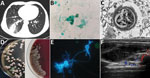 Emergomyces orientalis infection in a kidney transplant patient from Tibet. A) Pulmonary consolidation with the air bronchogram sign shown on a computed tomography scan. B) Microbes stained with Grocott-Gomori's methenamine silver in the bronchoalveolar lavage fluid sample (original magnification ×1,000). C) Pathological image of 1 yeast cell shown by electron microscopy in a necrotizing granuloma from paraffin-embedded pulmonary tissue (original magnification ×16,000). D) Tiny, slightly raised white colonies on Sabouraud agar on day 20 at 25°C (left) and grayish yellow furrowed colonies on blood agar on day 30 at 35°C (right) isolated from bronchoalveolar lavage fluid samples. E) Specific secondary α-shaped conidiophore shown with fluorescent calcium staining (original magnification ×1,000). F) Ultrasound revealed a soft tissue abscess in the patient’s right subcostalis.