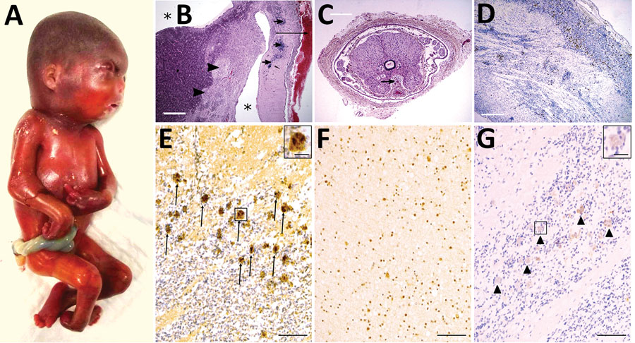 Pathologic findings including results of external examination, histological features of central nervous system, and immunohistochemical staining in a fetus from a woman in French Guiana who was found to be infected with Tonate virus. A) External examination of the body showing subcutaneous edema, microcephaly, craniofacial malformations (short forehead, flat midface), and severe arthrogryposis with upper and lower limb malformations with joint contractures. B) Histologic view of brain section stained in hematoxylin and eosin, displaying lateral ventricle enlargement (asterisk), meningeal hemorrhage (long arrow), diffuse calcifications (short arrows), and nodular heterotopia (arrowheads). Scale bar = 3 mm. C) Spinal cord section showing an abnormally shaped and atrophic spinal cord with the presence of siderophages (sign of premortem meningeal hemorrhage, arrow). Scale bar = 1 mm. D) CD68 immunohistochemistry demonstrating microglial activation and small clusters of microglia and macrophages in the brain (hematoxylin counterstain). Scale bar = 1 mm. E–G) Immunohistochemistry, using anti-TONV mouse serum, of patient (E), control (F), and negative control (G) brains. Note the strong staining of many positive cells in the patient (arrows and inset in panel E), compared to the control brain, where a moderately diffuse background signal is shown but without strong positive cells such as in the patient. In the negative control (without anti-TONV mouse serum antibody), there is a very slight staining (arrowheads and inset in panel G) in the same cells compared with those in the patient, indicating the background signal (color trapping) in these cells. Scale bars = 300 μm; insets in panels E and G = 20 μm.