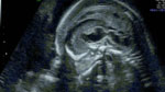 Ultrasonographic prenatal imaging of fetus with developmental abnormalities.