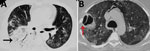 Noncontrast computed tomography scan of the thorax of a patient with coronavirus disease–associated mucormycosis, India, 2020. A) Pulmonary mucormycosis demonstrated as a large area of consolidations with patchy air trapping (black arrow), patchy ground-glass opacities, and septal thickening; B) large thick-walled cavity (red arrow) with surrounding ground-glass opacities.