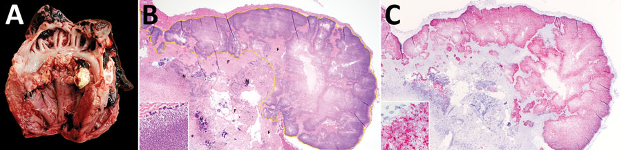 Lesions associated with swine vegetative endocarditis, United States, 2015–2020. A) Macroscopic findings of vegetative growth on the left atrioventricular heart valve leaflets. B) Histopathologic findings of inflammation characterized by necrotic leukocytes (N), fibrin (F), mineralization (M), and myriad bacterial colonization (yellow outline) along the surface of the heart valve (hematoxylin and eosin staining); original magnification ×40. Higher magnification image (inset) shows cocci bacteria in clusters and long chains; original magnification ×1,000. C) Streptococcus gallolyticus directly detected (red) on the surface of the heart valve by RNA in situ hybridization with a probe targeting the helix-hairpin helix domain–containing protein, ComEC/Rec2, and DNA pol III subunit delta genes specific to S. gallolyticus; original magnification ×40. Higher magnification image (inset) shows the bacteria labeled by the in situ hybridization probe; original magnification ×1,000. 