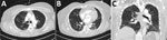 Chest computed tomography from hospital day 3 for a 59-year-old woman (case-patient 1) with new-onset systemic capillary leak syndrome and coronavirus disease showing A) the upper and B) lower lung fields in axial plane and C) the coronal plane. The scans showed bilateral scattered ground glass opacities consistent with mild-to-moderate infection with severe acute respiratory syndrome coronavirus 2. 