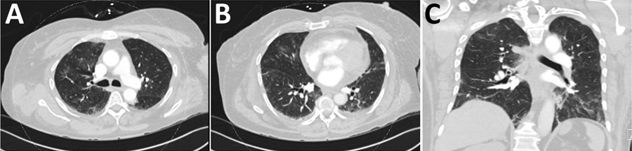 Chest computed tomography from hospital day 3 for a 59-year-old woman (case-patient 1) with new-onset systemic capillary leak syndrome and coronavirus disease showing A) the upper and B) lower lung fields in axial plane and C) the coronal plane. The scans showed bilateral scattered ground glass opacities consistent with mild-to-moderate infection with severe acute respiratory syndrome coronavirus 2. 