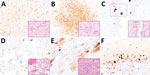 Histopathologic and immunohistochemical examination of the gray seal (Halichoerus grypus), common seal (Phoca vitulina), and red fox (Vulpes vulpes) infected with highly pathogenic avian influenza A subtype H5N8, United Kingdom. Serial tissue sections were stained with hematoxylin and eosin. Immunohistochemical examination was undertaken using anti–influenza A nucleoprotein primary antibody (Statens Serum Institute, https://en.ssi.dk). Insets show histopathologic study results. A) Nonsuppurative polioencephalitis and presence of virus antigens in neurons in the cerebrum, common seal (Phoca vitulina). Original magnification ×10, inset ×40. B) Nonsuppurative polioencephalitis with neuronophagia and association of virus antigens, red fox. Original magnification ×10, inset ×40. C) Ependymal necrosis and the association of virus antigens, fox. Original magnification and inset ×40; area of interest also shown. D) Diffuse alveolar damage and presence of virus in type I alveolar pneumocytes, red fox. Original magnification and inset ×40. E) Cardiomyonecrosis associated with virus antigens in cardiomyocytes, red fox. Original magnification and inset ×40. F) Virus antigens in granular and molecular layer of the cerebellum, red fox. Original magnification ×20, inset ×40. Serial tissue sections were stained with hematoxylin and eosin. Immunohistochemical examination was undertaken using anti–influenza A nucleoprotein primary antibody (Statens Serum Institute, https://en.ssi.dk). Insets show histopathologic study results. 
