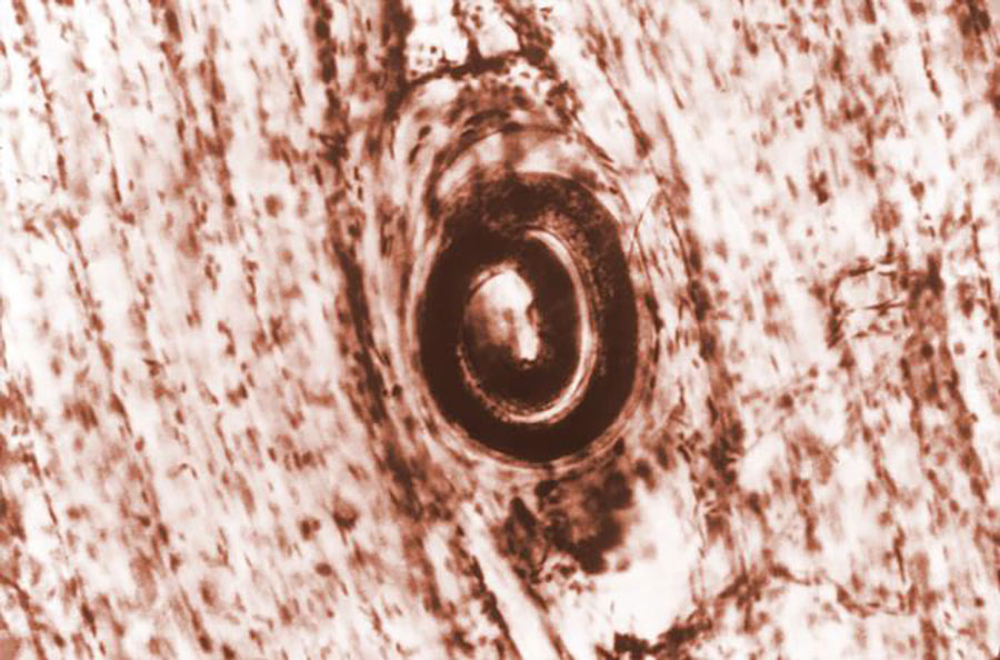 Photomicrograph showing a Trichinella spiralis cyst that was embedded in a muscle tissue specimen, in a case of trichinellosis acquired by ingesting meat containing cysts (encysted larvae) of Trichinella sp. Source: CDC/Dr. Irving Kagan (https://phil.cdc.gov/Details.aspx?pid=10180).