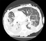 Computed tomography image of the chest showing bilateral dense consolidations and right-sided pleural effusion in 77-year-old man with severe acute respiratory syndrome coronavirus 2 who was later found to be co-infected with Bordetella hinzii. A, anterior; P, posterior