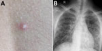 Images of 15-year-old boy (patient 1) with melioidosis, Kerala, India, 2019. A) Vesicular lesion on trunk. B) Chest radiograph showing diffuse heterogeneous opacities suggestive of acute respiratory distress syndrome.