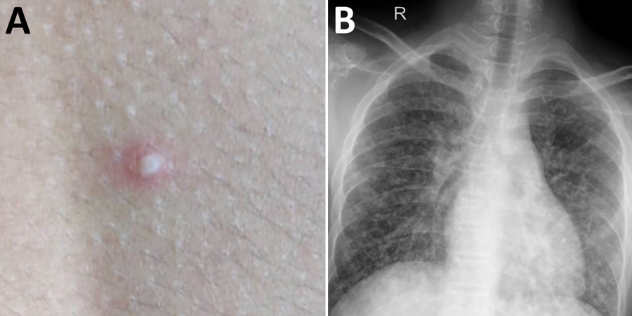 Images of 15-year-old boy (patient 1) with melioidosis, Kerala, India, 2019. A) Vesicular lesion on trunk. B) Chest radiograph showing diffuse heterogeneous opacities suggestive of acute respiratory distress syndrome.
