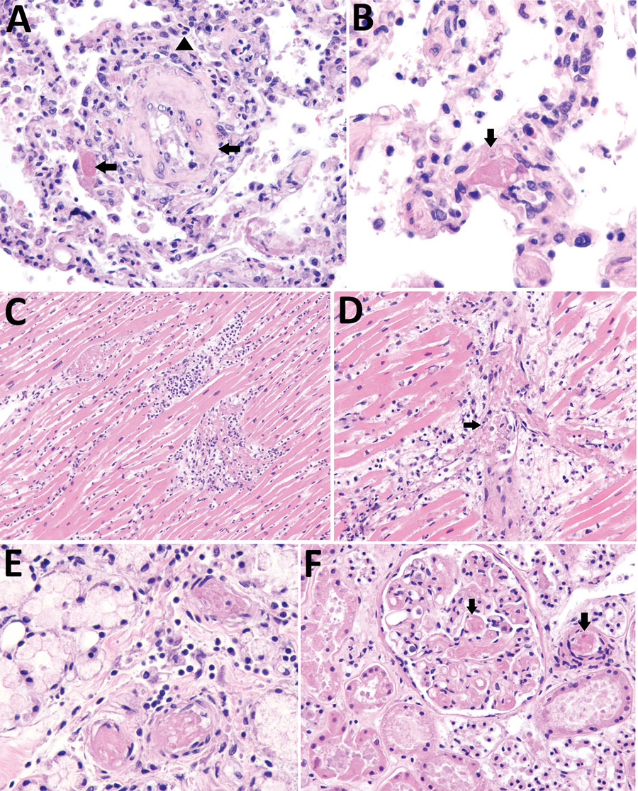 Histopathologic findings in a fatal case of multisystem inflammatory syndrome in adult after natural severe acute respiratory syndrome coronavirus 2 infection and coronavirus disease vaccination, Tennessee, USA, 2021. A) Lung tissue shows capillaritis characterized by neutrophilic inflammation and necrosis within interalveolar septa (arrowhead). Fibrin and organizing intraluminal microthrombi in small arteries are also seen (arrows). Original magnification 20×. B) Higher magnification of fibrin microthrombus within a lung vessel (arrow). Original magnification 63×. C) Heart tissue shows myocarditis with myocyte necrosis and mixed inflammatory infiltrate. Original magnification 20×. D) Higher magnification cardiac vessel showing microthrombus and perivascular mononuclear inflammatory infiltrate (arrow). Original magnification 40×. E) Stomach tissue shows submucosal microthrombi with perivascular lymphocytic infiltrate. Original magnification 63×. F) Kidney tissue shows multiple fibrin thrombi in glomerular (arrow) and interstitial capillaries (arrow). Original magnification 40×.