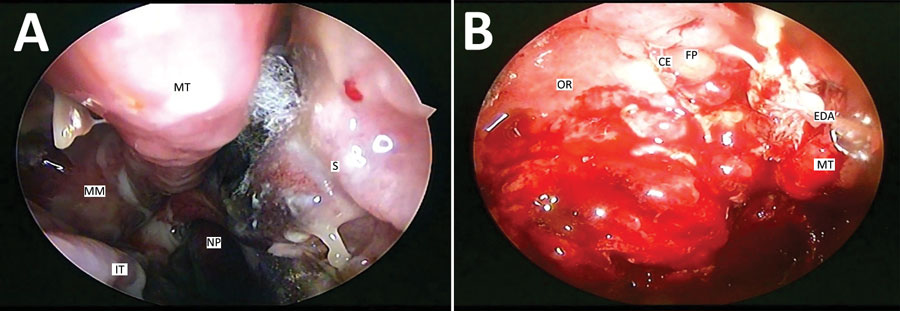 Diagnostic endoscopic examinations of the nasal cavities of 2 patients with mucormycosis after coronavirus disease, Pune, India. A) Right nasal cavity shows crusting in the region of the middle meatus, blackish eschar with fungal elements between the middle turbinate and the nasal septum. Necrosis has begun setting in the part of the nasal septum below the region of the eschar. Mucopurulent discharge is seen trickling from the middle meatus to the nasopharynx because of underlying sinusitis. The inferior turbinate has undergone hypertrophy because of the underlying disease. B) Left nasal cavity shows extradural abscess being drained transnasally. Multiple polyps are noted in the region of the ethmoidal fovea. The crista ethmoidalis, left middle turbinate, and the right orbital roof are destroyed because of the underlying invasion by mucor. CE, crista ethmoidalis; EDA, extradural abscess; FP, ethmoidal fovea; IT, inferior turbinate; MM, middle meatus; MT, middle turbinate; NP, nasopharynx; OR, orbital roof; S, septum.