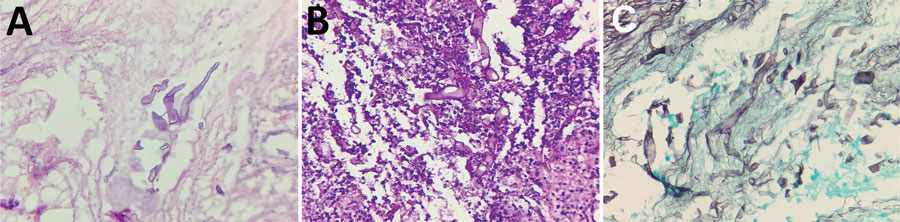 Histopathologic findings for necrotic tissue samples from patients with mucormycosis after coronavirus disease, Pune, India. A) Hematoxylin and eosin stain shows nonpigmented, wide, thin-walled ribbonlike pleomorphic broad aseptate hyphae of mucormycosis (original magnification ×40). B) Periodic acid–Schiff stain shows pleomorphic broad aseptate hyphae of mucormycosis (original magnification ×40). C) Methenamine silver stain shows nonpigmented (hyaline), pauciseptate, ribbonlike hyphae with right-angled branching consistent with Mucorales genera (original magnification ×40).