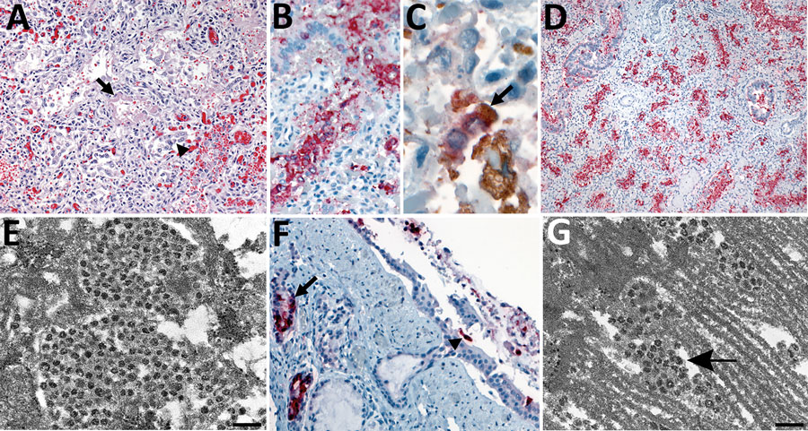 Pulmonary histopathologic, immunohistochemical (IHC), in situ hybridization, and ultrastructural findings in tissues from a neonate in the United States with severe acute respiratory syndrome coronavirus 2 (SARS-CoV-2). A) Lower magnification of the lung showing diffuse alveolar damage, characterized by type II pneumocyte hyperplasia (arrowhead), hyaline membrane (arrow), and interstitial mononuclear infiltrate. Original magnification ×20. B) Extensive intra-alveolar immunostaining by spike protein SARS-CoV-2 IHC assay. Original magnification ×40. C) Double-stain IHC assay showing rare macrophages with SARS-CoV-2/CD-163–positive immunostaining. Red, SARS-CoV-2; brown, CD-163 antibody (arrow). Original magnification ×63. D) Extensive staining of SARS-CoV-2 genomic RNA in pneumocytes by nucleocapsid gene in situ hybridization assay. Original magnification ×10. E) Electron microscopy (EM) image of a pneumocyte containing accumulations of intracellular viral particles. Scale bar indicates 200 nm; viral particles were on average 65 nm in diameter, smaller than commonly observed because of shrinkage during processing. F) Immunostaining of tracheal epithelial cells (arrowhead) and submucosal glands (arrow) by SARS-CoV-2 nucleocapsid IHC assay. Original magnification ×20. G) EM image of a ciliated epithelial cell with extracellular viral particles (arrow) associated with the cilia. Scale bar indicates 200 nm. EM images were collected from 4-μm sections of formalin-fixed, paraffin-embedded tissues affixed to glass slides that were embedded for EM.
