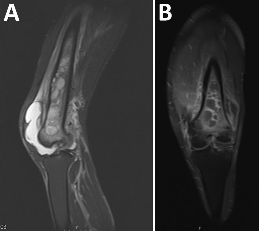 Melioidosis manifesting as chronic femoral osteomyelitis of the left leg in patient from Ghana. A) Magnetic resonance imaging showing extensive femoral osteomyelitis. FFB) Magnetic resonance imaging showing extensive osteomyelitis.