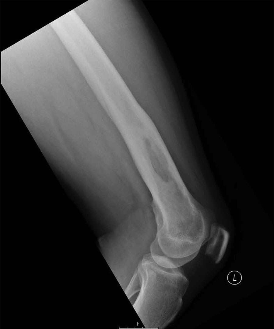 Follow-up radiograph for patient from Ghana with melioidosis manifesting as chronic femoral osteomyelitis of the left leg. Radiograph taken 12 months after initial assessment shows no remaining evidence of infection.