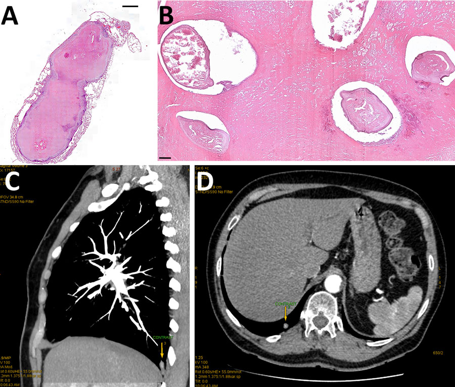 Histologic examination of resected tissue from a 66-year-old woman from southwestern Slovakia. A, B) Cross section showing Dirofilaria immitis nematodes embedded in necrotic material obtained from well-defined pulmonary nodule. Hematoxylin and eosin staining; original magnification ×20 for panel A, ×100 for panel. C, D) Chest computed tomography scan showing a subpleural focal lesion in the S10 segment of the right lung (arrows).