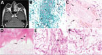 Radiologic and pathologic findings in a 43-year-old immunocompromised man with chronic granulomatous disease and diagnosed invasive fungal sinusitis caused by Rigidoporus corticola (Oxyporus corticola) infection, United States. A) Magnetic resonance imaging of the head showing mucosal thickening and near opacification in the left frontal, left ethmoid, left maxillary, and left sphenoid sinuses, and the left nasal cavity. No findings suggest extra-sinus extension. B) Debrided sinus tissue stained with Gomori methenamine silver. Arrows indicate numerous septate hyphae with predominantly right-angle branching. Original magnification ×600. C) Hematoxylin and eosin stain of blood vessels. Arrows indicate permeation (angioinvasion). Original magnification ×600. D) Hematoxylin and eosin stain of the sinonasal ossicles. Arrows indicate infiltration consistent with invasive fungal disease. Original magnification ×600. E, F) Periodic acid–Schiff-diastase–stained sinus tissue. Arrows indicate bulge-like (E) and hook-like (F) hyphal outgrowths potentially representing clamp connections, characteristic of filamentous basidiomycetes, that were detected upon careful examination. Original magnification ×1,000.