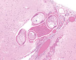 Formalin-fixed brainstem specimen from red ruffed lemur (Varecia rubra) infected with Angiostrongylus cantonensis nematodes at a zoo in Louisiana, USA. Hematoxylin and eosin stain shows adult nematodes measuring ≈50–70 μm in diameter with 3–4 μm thick, smooth, eosinophilic cuticle and prominent lateral cords. Nematodes have a coelomyarain musculature and a pseudocoelom that contains a reproductive tract and an intestinal tract, lined by multinucleated cells. Original magnification ×10.