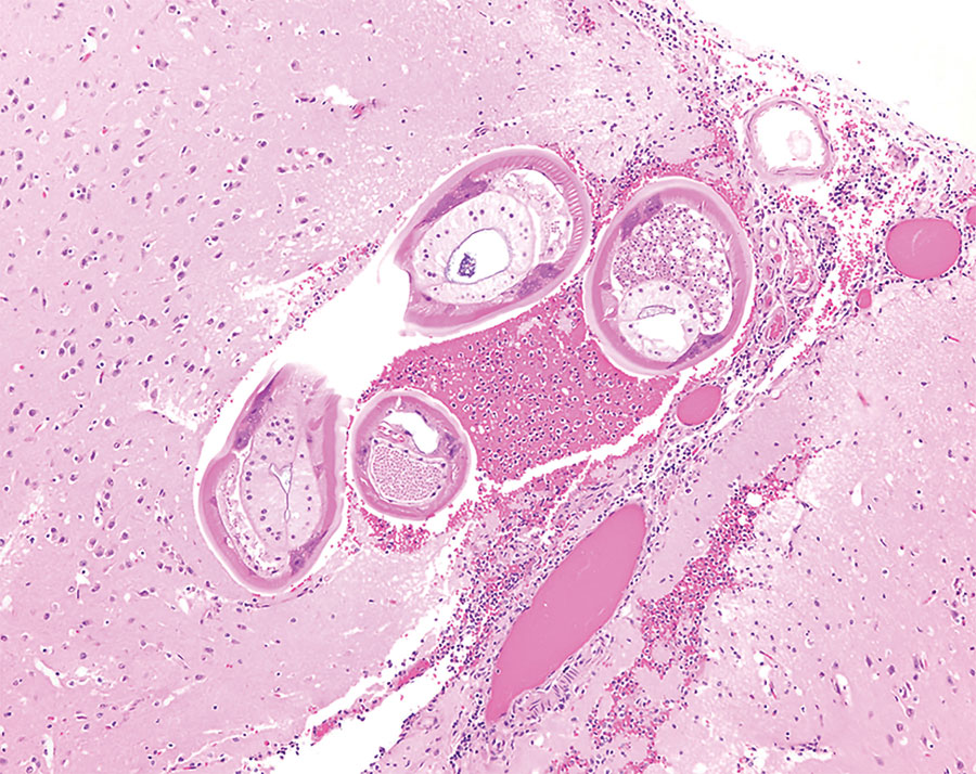 Formalin-fixed brainstem specimen from red ruffed lemur (Varecia rubra) infected with Angiostrongylus cantonensis nematodes at a zoo in Louisiana, USA. Hematoxylin and eosin stain shows adult nematodes measuring ≈50–70 μm in diameter with 3–4 μm thick, smooth, eosinophilic cuticle and prominent lateral cords. Nematodes have a coelomyarain musculature and a pseudocoelom that contains a reproductive tract and an intestinal tract, lined by multinucleated cells. Original magnification ×10.