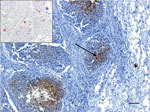 Immunohistochemistry testing for influenza A virus antigen in lung tissue of an adult male harbor seal, British Columbia, Canada. Viral antigen (arrow) was detected by immunohistochemistry within the bronchiolar-associated lymphoid tissue but not in adjacent lung parenchyma (*). Viral RNA could also be detected in bronchiolar-associated lymphoid tissue by in situ hybridization (inset, pink areas). Scale bar = 50 μm.